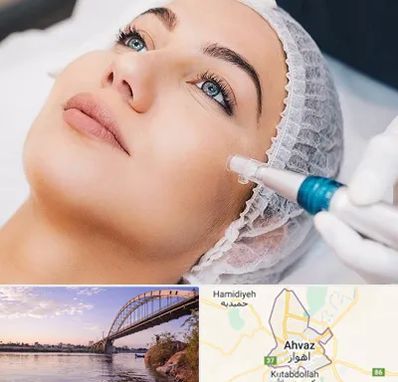 مزونیدلینگ در اهواز