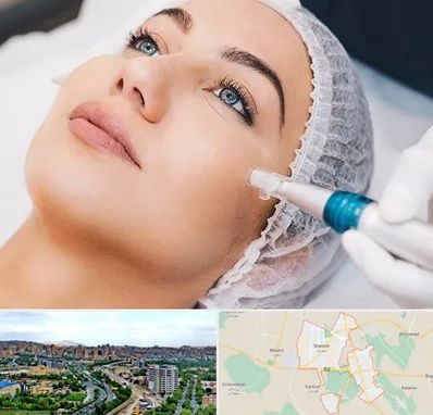 مزونیدلینگ در شهریار