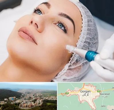 مزونیدلینگ در گرگان