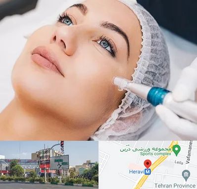 مزونیدلینگ در هروی 