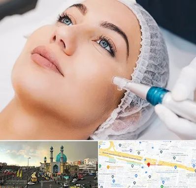 مزونیدلینگ در رسالت 