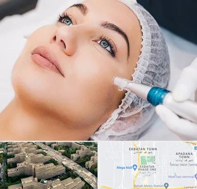 مزونیدلینگ در اکباتان 