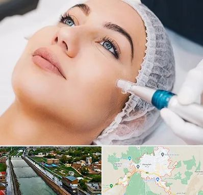 مزونیدلینگ در مراغه