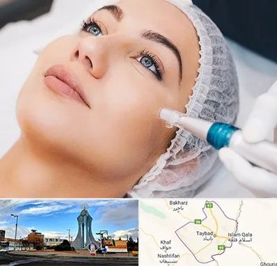 مزونیدلینگ در تایباد