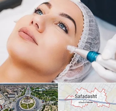 مزونیدلینگ در صفادشت