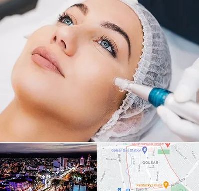 مزونیدلینگ در گلسار رشت 