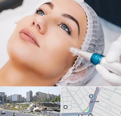 مزونیدلینگ در هفت تیر