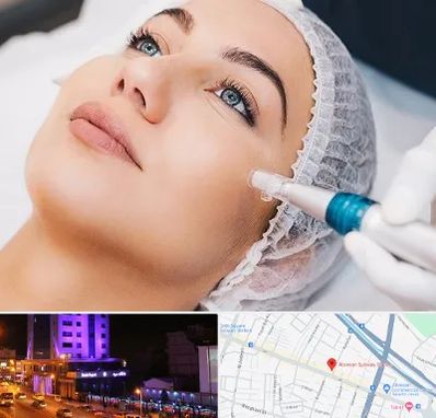 مزونیدلینگ در آبرسان تبریز