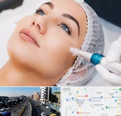 مزونیدلینگ در پیروزی 