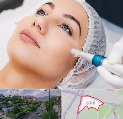 مزونیدلینگ در لویزان
