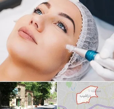 مزونیدلینگ در دزاشیب