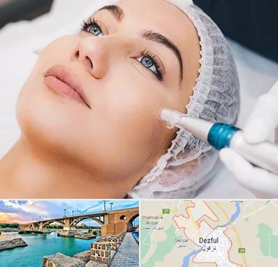 مزونیدلینگ در دزفول