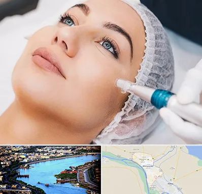 مزونیدلینگ در خرمشهر