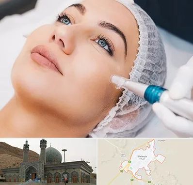 مزونیدلینگ در شهرضا