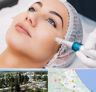 مزونیدلینگ در رودسر