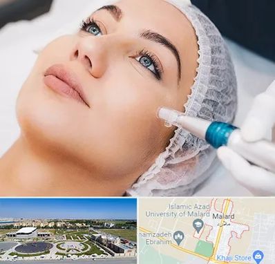 مزونیدلینگ در ملارد