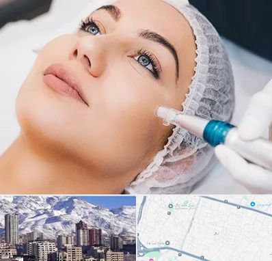 مزونیدلینگ در ازگل