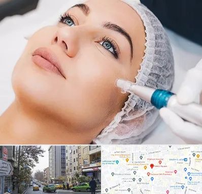 مزونیدلینگ در فاطمی 