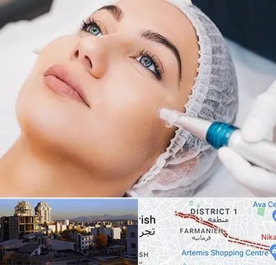 مزونیدلینگ در فرمانیه 