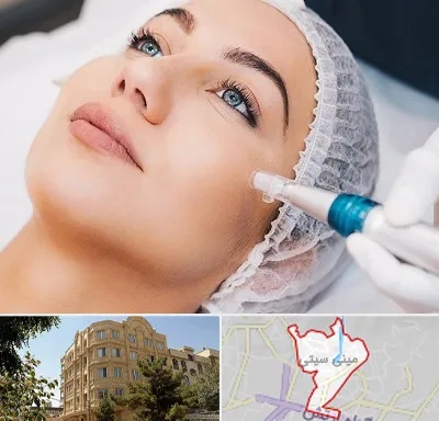 مزونیدلینگ در مینی سیتی