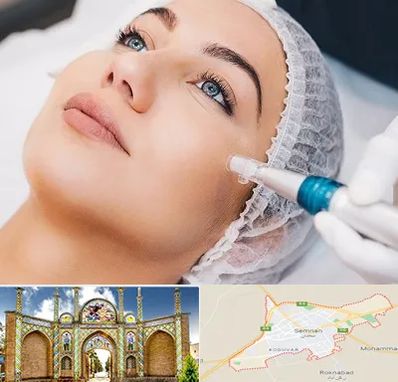 مزونیدلینگ در سمنان