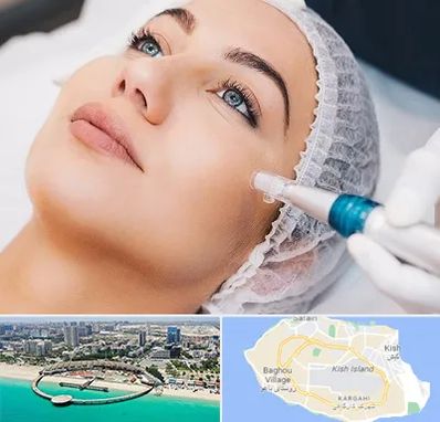 مزونیدلینگ در کیش