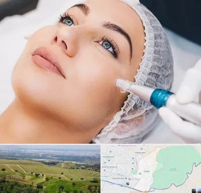 مزونیدلینگ در سوهانک