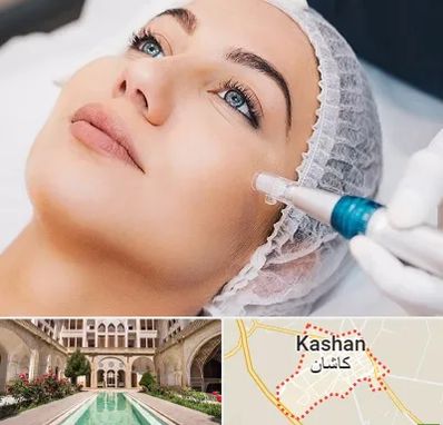 مزونیدلینگ در کاشان