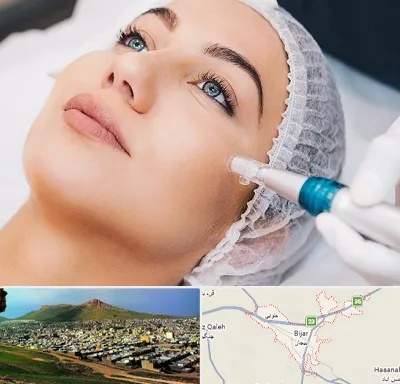 مزونیدلینگ در بیجار
