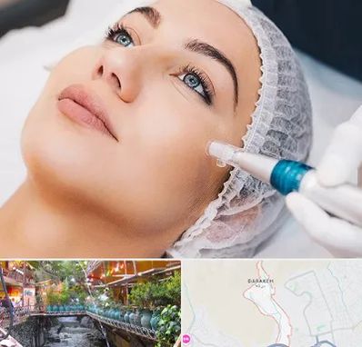 مزونیدلینگ در درکه