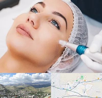 مزونیدلینگ در رودهن