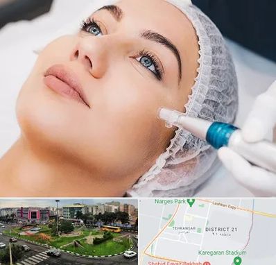 مزونیدلینگ در تهرانسر 