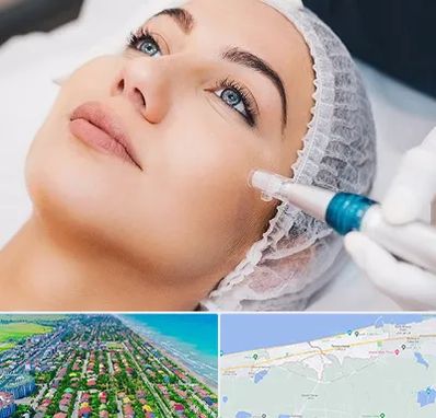 مزونیدلینگ در فریدونکنار