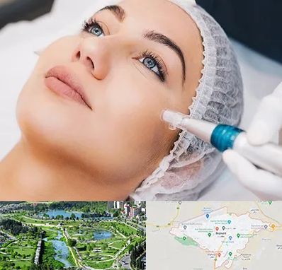 مزونیدلینگ در بجنورد