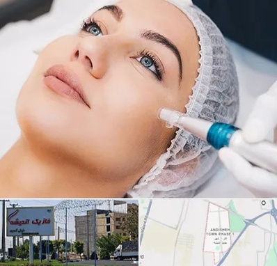 مزونیدلینگ در فاز یک اندیشه