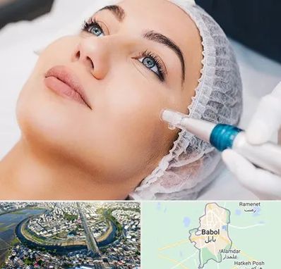 مزونیدلینگ در بابل