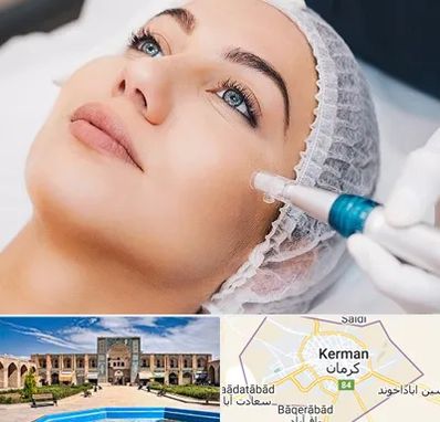 مزونیدلینگ در کرمان