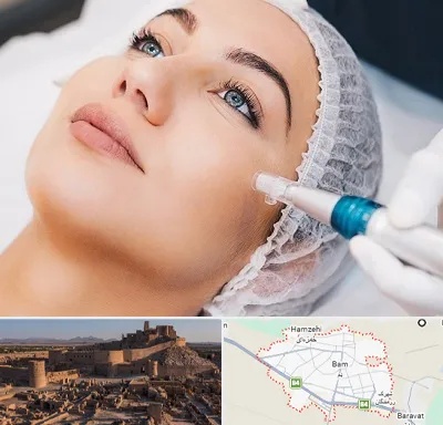 مزونیدلینگ در بم