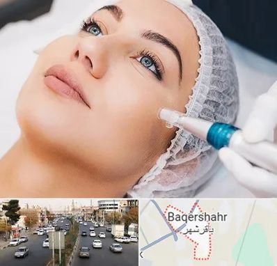 مزونیدلینگ در باقرشهر