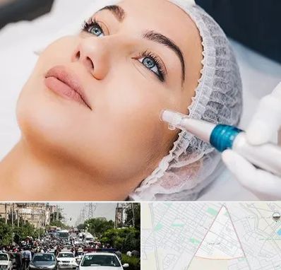 مزونیدلینگ در سیدی مشهد