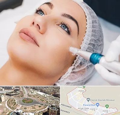 مزونیدلینگ در پرند