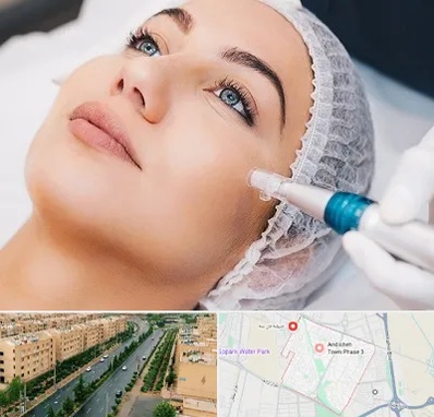 مزونیدلینگ در فاز سه اندیشه