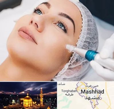 مزونیدلینگ در مشهد