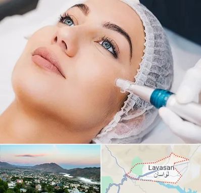 مزونیدلینگ در لواسان