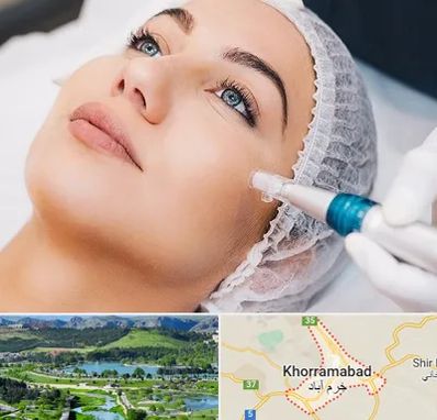 مزونیدلینگ در خرم آباد