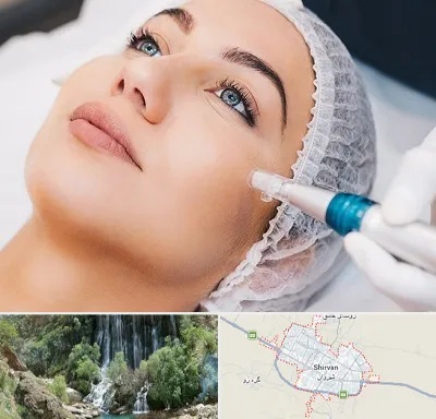 مزونیدلینگ در شیروان
