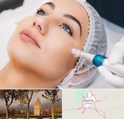 مزونیدلینگ در تویسرکان