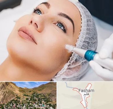 مزونیدلینگ در فشم