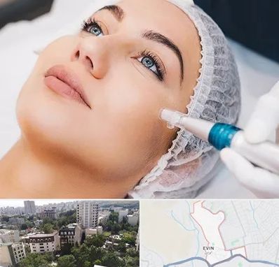 مزونیدلینگ در اوین