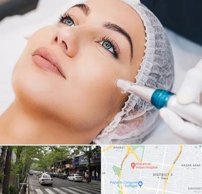 مزونیدلینگ در ظفر 